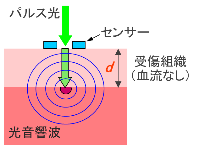 光音響法による熱傷深度診断の原理 